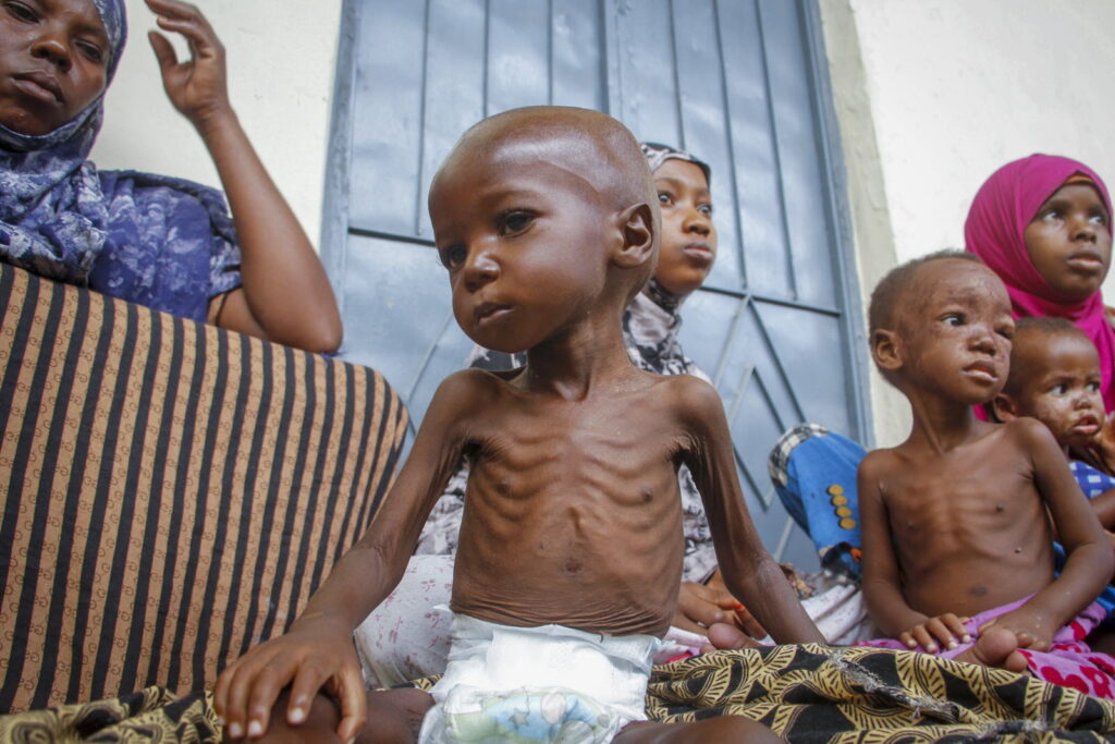 Journée mondiale contre la faim : plus de 811 millions de personnes souffrent encore de la faim dans le monde, alerte l’UNICEF Un enfant de 2 ans souffrant de malnutrition en Somalie. Photo d'illustration Sipa / AP / Farah Abdi Warsameh